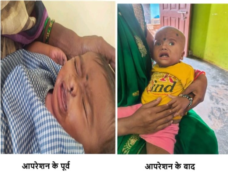 रायपुर : चिरायु योजना बच्चों के लिए भी बनी वरदान,,,   