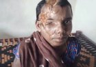 मानवता और संवेदनशील प्रशासन की मिसाल : भालू हमले की पीड़िता प्रेमबाई के घर पहुंचेगा जिला मेडिकल बोर्ड,  डॉ. अविनाश खरे ने दिखाई मानवीय संवेदना, दिव्यांग महिला को अब नहीं लगाने पड़ेंगे अस्पताल के चक्कर,