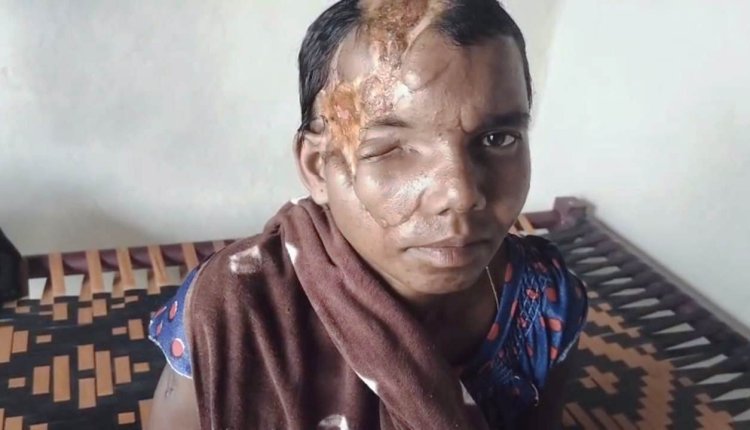 मानवता और संवेदनशील प्रशासन की मिसाल : भालू हमले की पीड़िता प्रेमबाई के घर पहुंचेगा जिला मेडिकल बोर्ड,  डॉ. अविनाश खरे ने दिखाई मानवीय संवेदना, दिव्यांग महिला को अब नहीं लगाने पड़ेंगे अस्पताल के चक्कर,